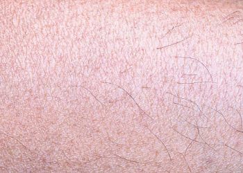 Close-up of dry, scaly human skin with visible flaking and fine cracks.