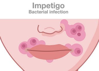 Illustrated face with impetigo showing red sores and blisters around the mouth