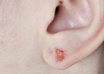 Infected earlobe with swelling, redness, and pus from piercing