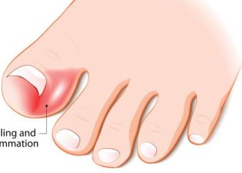 Symptoms of Ingrown Toenail