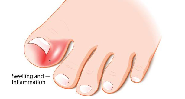 Symptoms of Ingrown Toenail
