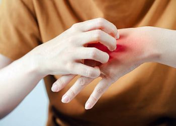 Symptoms of Insect Bites