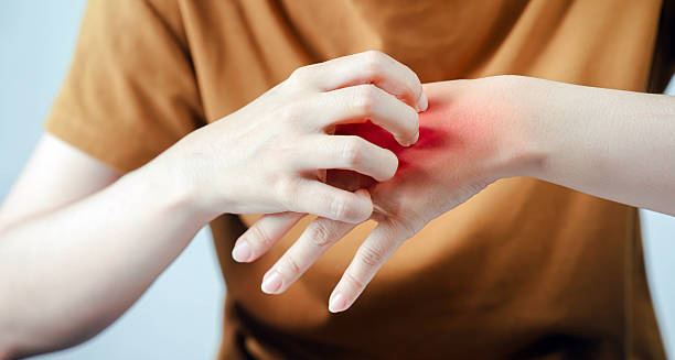 Symptoms of Insect Bites