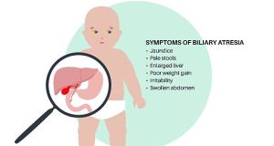 Illustration of a baby with jaundice and a magnified view of the liver showing symptoms of biliary atresia
