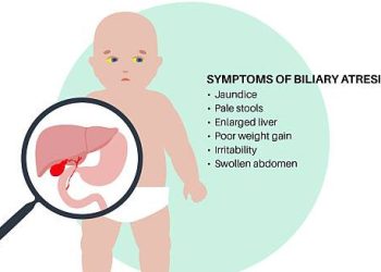 Illustration of a baby with jaundice and a magnified view of the liver showing symptoms of biliary atresia