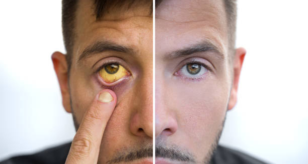 Split image showing one side of a man with yellow eyes and the other side with normal eyes, indicating symptoms of jaundice