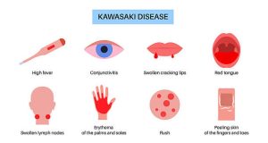 Illustration showing common symptoms of Kawasaki Disease including fever, rash, and red eyes
