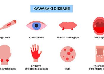 Illustration showing common symptoms of Kawasaki Disease including fever, rash, and red eyes
