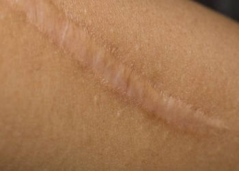 Close-up of a raised keloid scar on dark skin