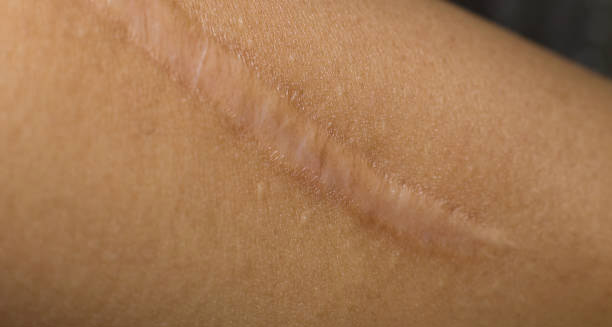 Close-up of a raised keloid scar on dark skin