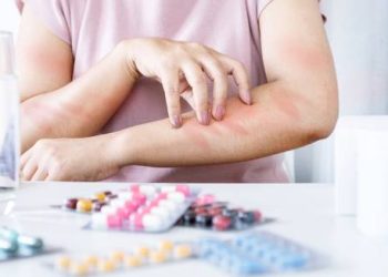 Woman scratching allergic rash on arms with allergy medication on table