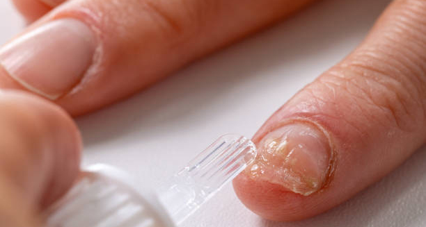 Treatment of Fungal Nail Infection