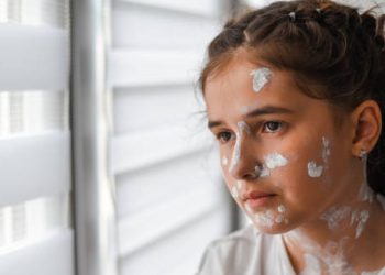 Young girl with cream on her face for German measles treatment