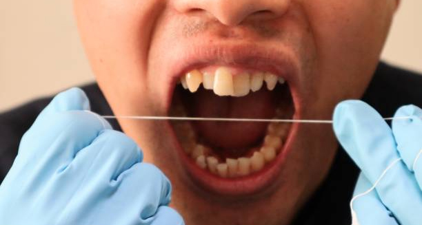 Dentist demonstrating dental flossing as part of gum disease treatment