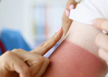 Treatment of Heat Rash