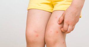 Child with Henoch-Schönlein Purpura rash on legs receiving care