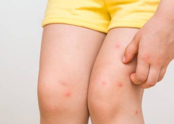 Child with Henoch-Schönlein Purpura rash on legs receiving care