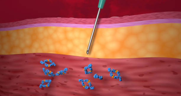 Illustration showing injection of medication into skin layers to treat hidradenitis suppurativa inflammation