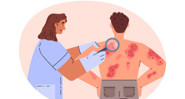 Doctor treating hives rash on a man’s back with a magnifying glass