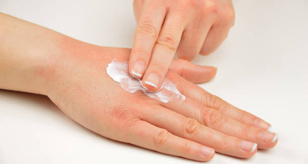 Applying moisturising cream to hand as treatment for ichthyosis