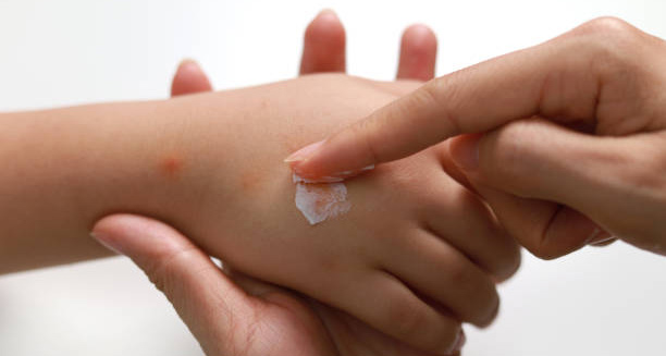 Applying cream to insect bites on a child's hand