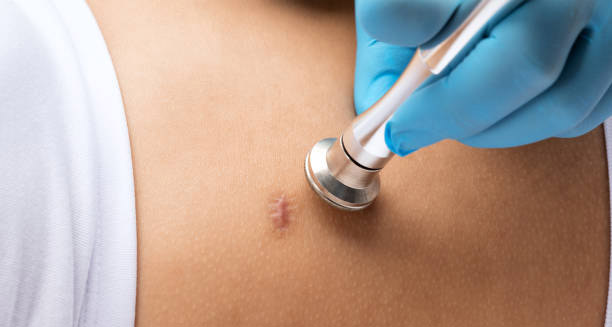 Doctor examining a small keloid scar on the chest with a stethoscope during treatment consultation