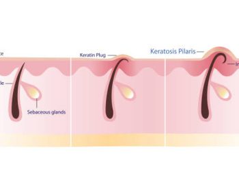 Illustration showing the causes of keratosis pilaris with keratin plugs and ingrown hair