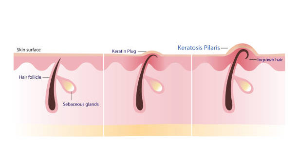 Illustration showing the causes of keratosis pilaris with keratin plugs and ingrown hair