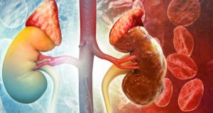 Illustration comparing a healthy kidney with an infected kidney showing tissue damage