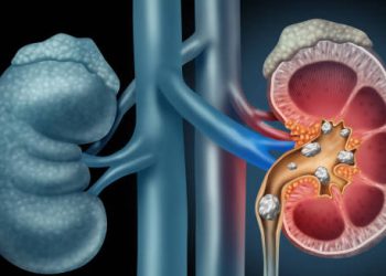 Illustration of kidney with stones showing internal buildup and blockage