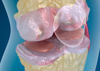 Causes of Knee Cartilage Damage