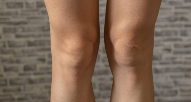 Causes of Knock Knees