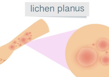 Causes of Lichen Planus