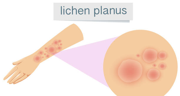 Causes of Lichen Planus
