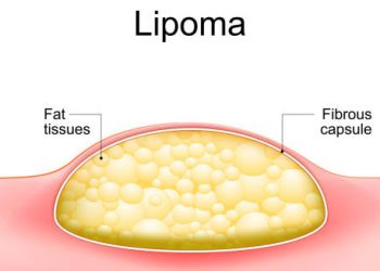 Causes of Lipoma