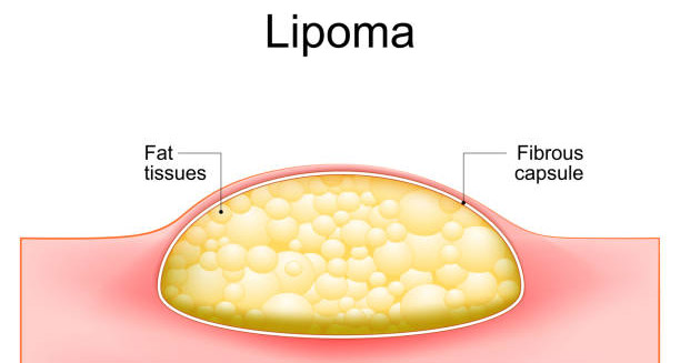 Causes of Lipoma