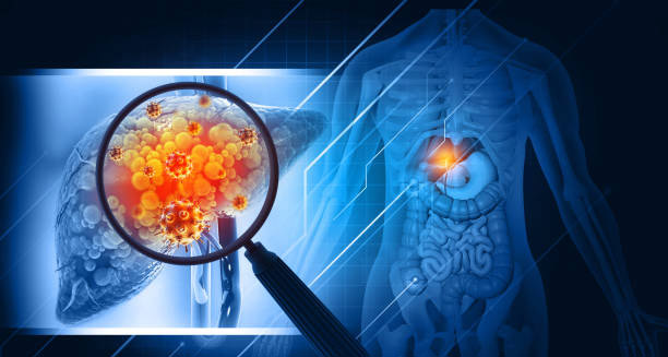 Causes of Liver Cancer