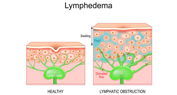 Causes of Lymphoedema