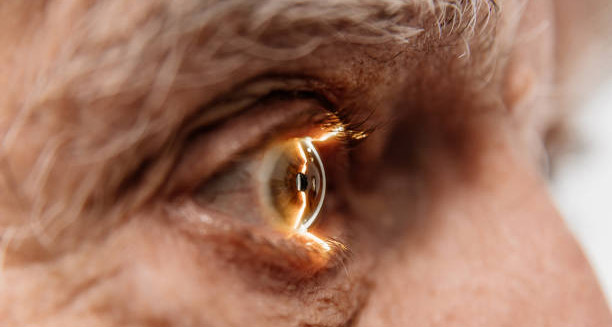 Causes of Macular Hole