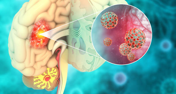 Causes of Malignant Brain Tumour