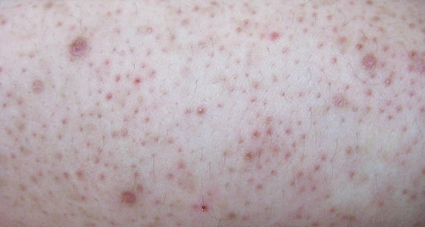 Close-up of severe keratosis pilaris with inflamed bumps and scarring