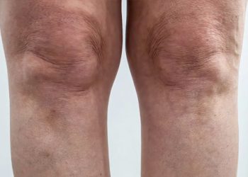 Complications of Knock Knees