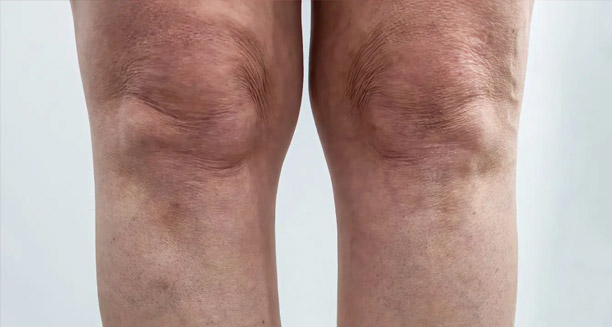 Complications of Knock Knees