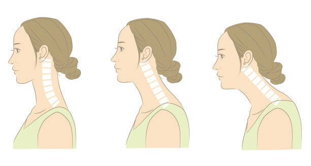 Complications of Kyphosis