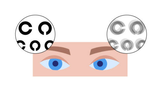 Complications of Lazy Eye