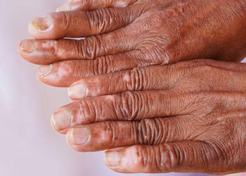 Complications of Leprosy