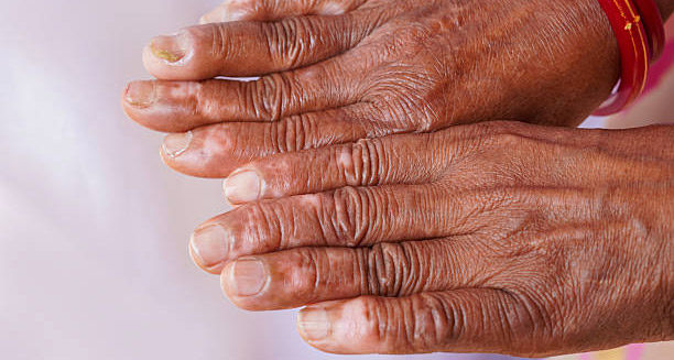 Complications of Leprosy