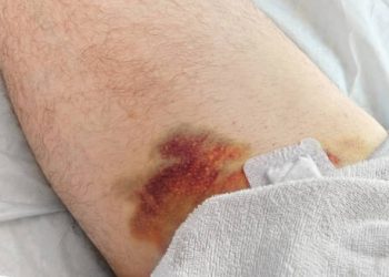 Complications of Leukaemia