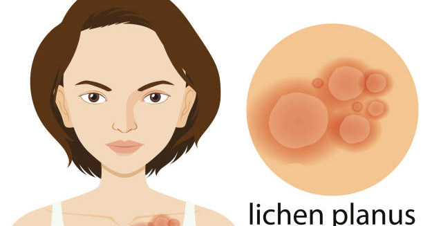 Complications of Lichen Planus