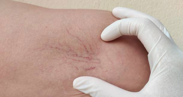 Complications of Lipoedema